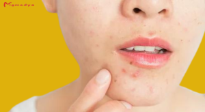 Read more about the article Do you suffer from regular pimples on your chin, here’s what it really means