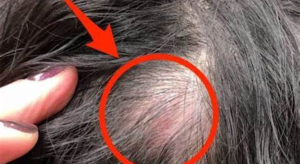 Read more about the article It looked like a pimple on his head, but what they pulled out shocked them