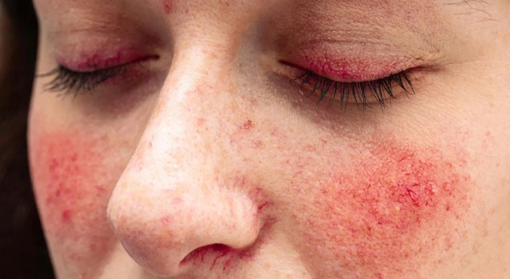 Warning signs of lupus you need to know