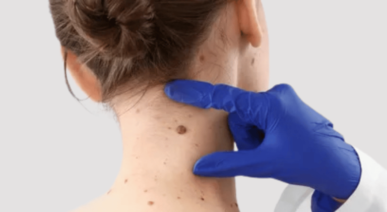 How can skin tags be treated?