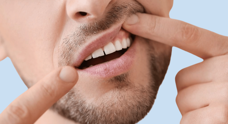 Gum recession: everything you need to know