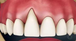 Read more about the article Gum recession: everything you need to know