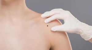 Read more about the article How can skin tags be treated?