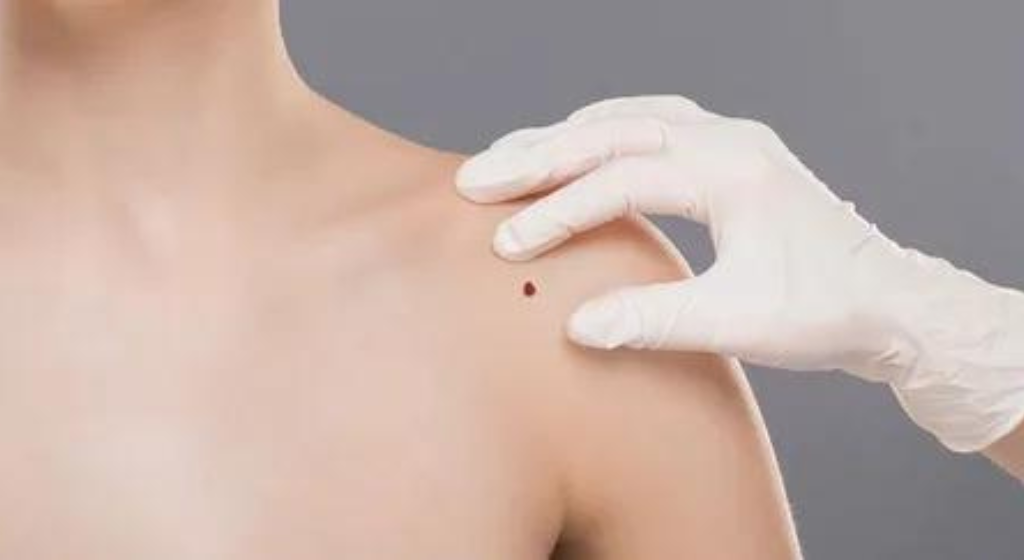 How can skin tags be treated?