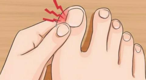 Read more about the article How to get rid of a painful nail without a doctor