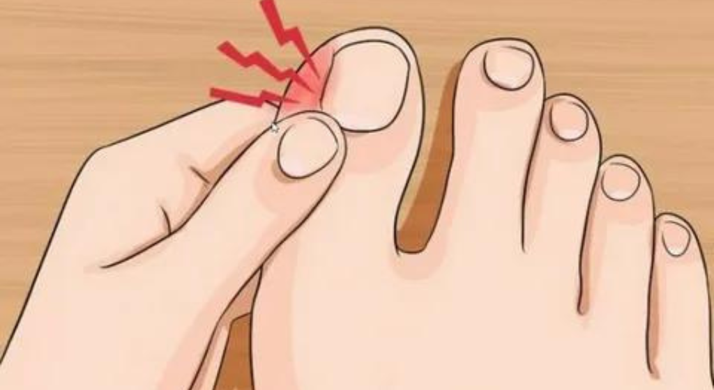 How to get rid of a painful nail without a doctor