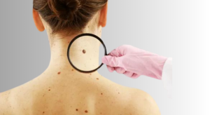 Read more about the article Symptoms of skin cancer that you should know