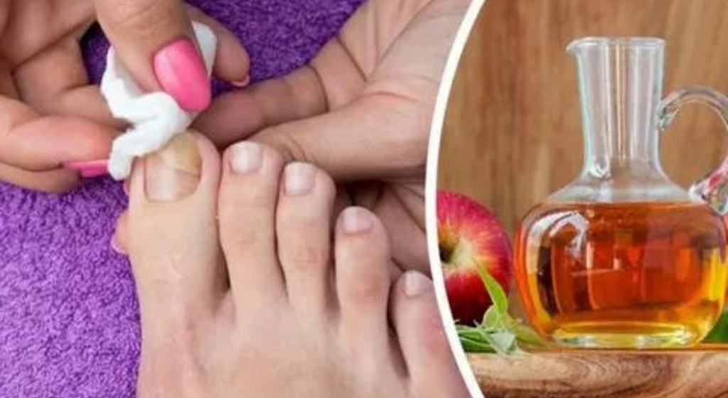 Read more about the article Treating Nail Fungus with Vinegar: How Effective Is It?