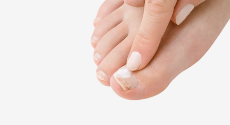 Treating Nail Fungus with Vinegar: How Effective Is It?